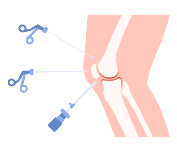 Arthroscopy