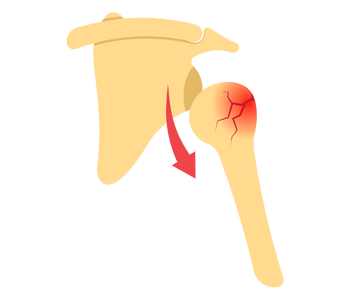 Fracture & Dislocation Treatment