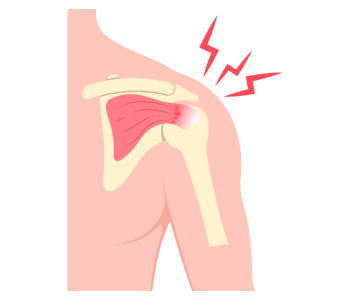 Rotator Cuff Tears