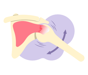 SLAP Tear Surgery