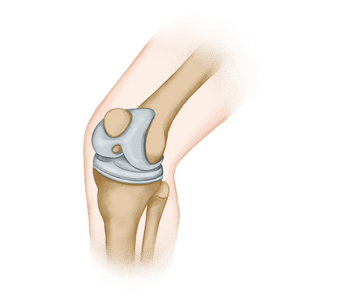 Total Knee Replacement Surgery