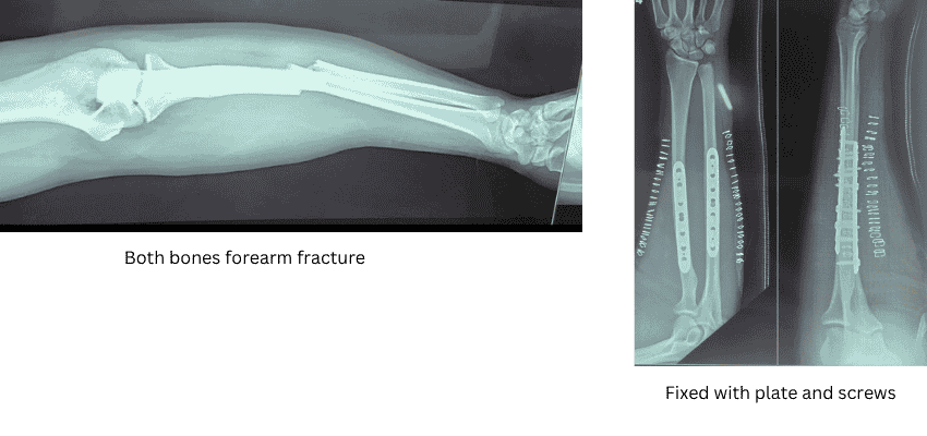 Both bones forearm fracture