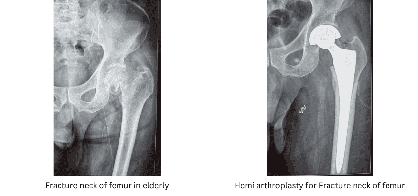 Femur Hip