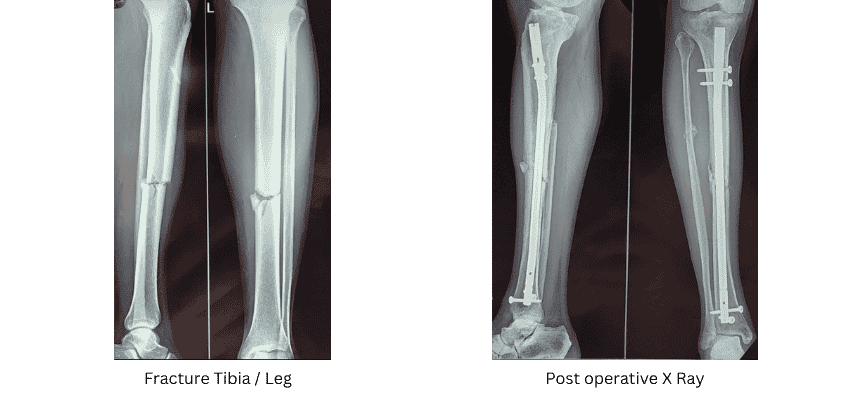 Fracture & Dislocation