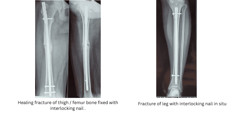 femur bone