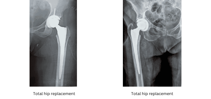 Total Hip Replacement