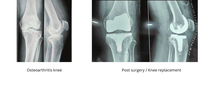 knee replacement